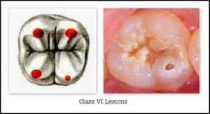 Class 6 caries in GV Black Classification 